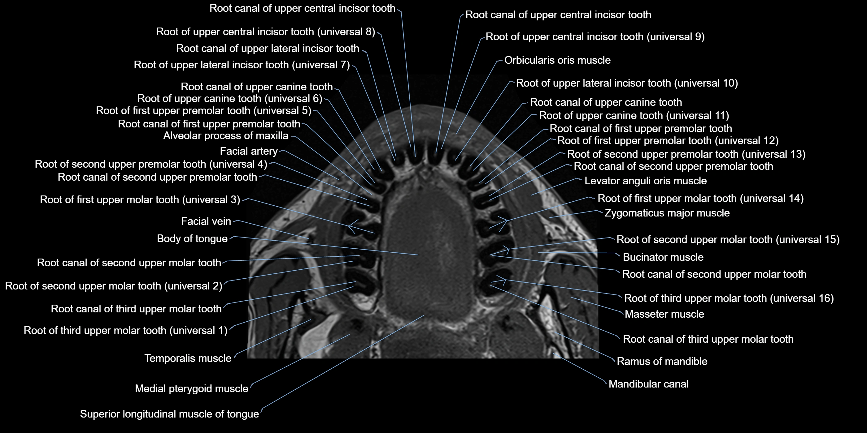Dental MRI( tooth) axial labelled  cross sectional 3T anatomy -img-00004.webp